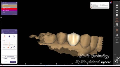 #design #naildesign #dental #dentaldesign #exocadexpert
