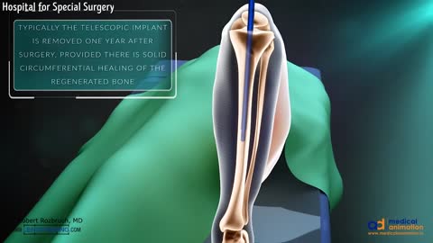 How Leg Surgeries Are Done