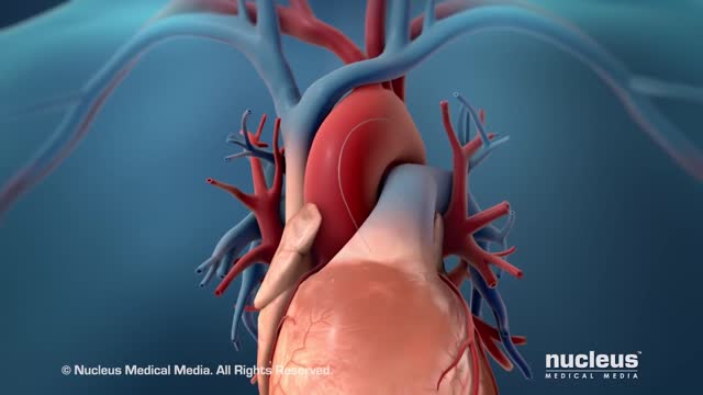 Coronary Angioplasty (Femoral Access)