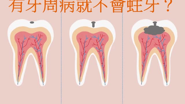 沒蛀牙就有牙周病 有牙周病就不會蛀牙？