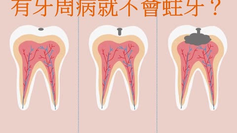 沒蛀牙就有牙周病 有牙周病就不會蛀牙？