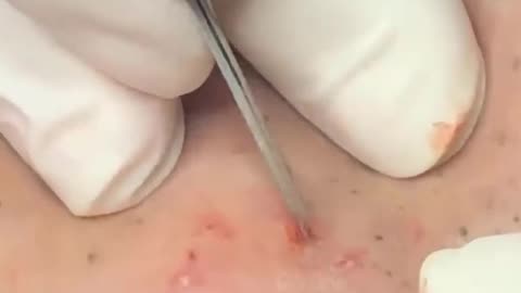 pimple popping