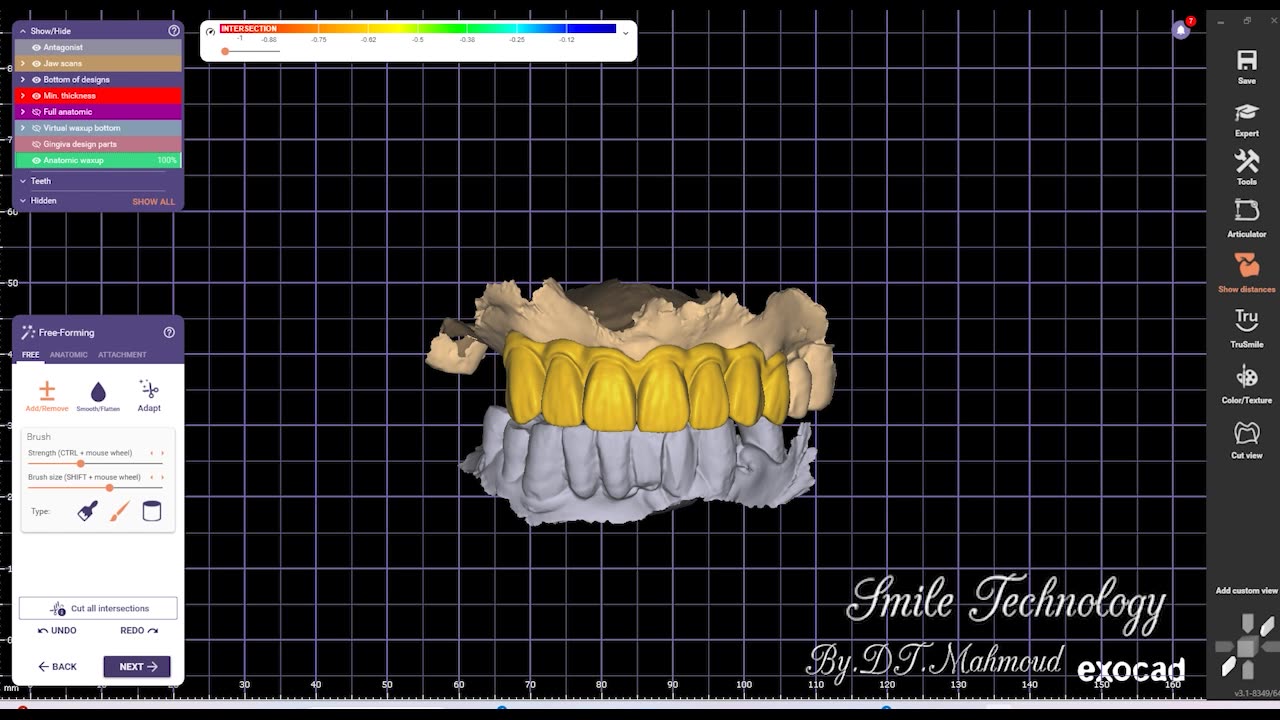 #design #naildesign #dental #dentaldesign #exocadexpert