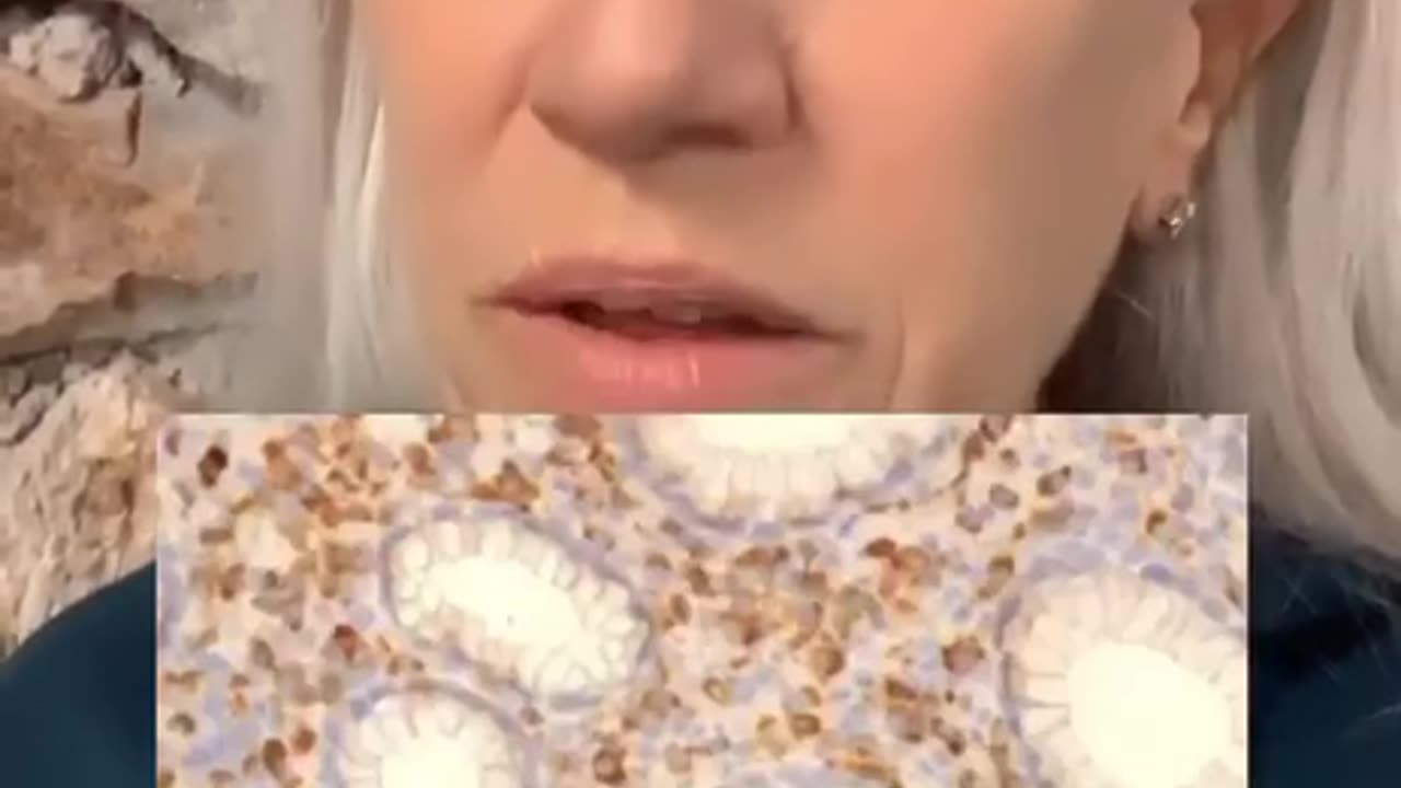 They are finding spike proteins from the jab right in the middle of cancer cells