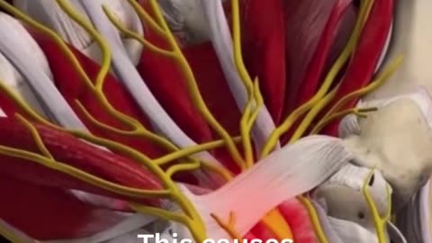 Carpal tunnel syndrome (CTS)