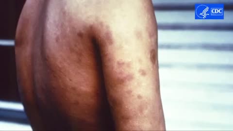 Leprosy Outbreak In Florida? Isn't that where Bill Gates released his GMO mosquitos?