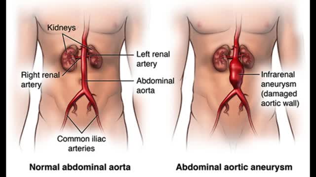 abdominal aortic aneurysm (AAA)