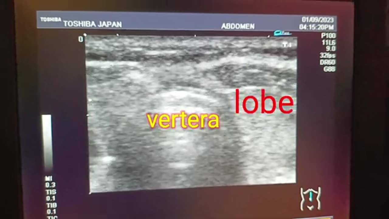 Complex Syst in Left Lobe of Thyroid With Linear Probe l Multinodular goiter l cold nodule l