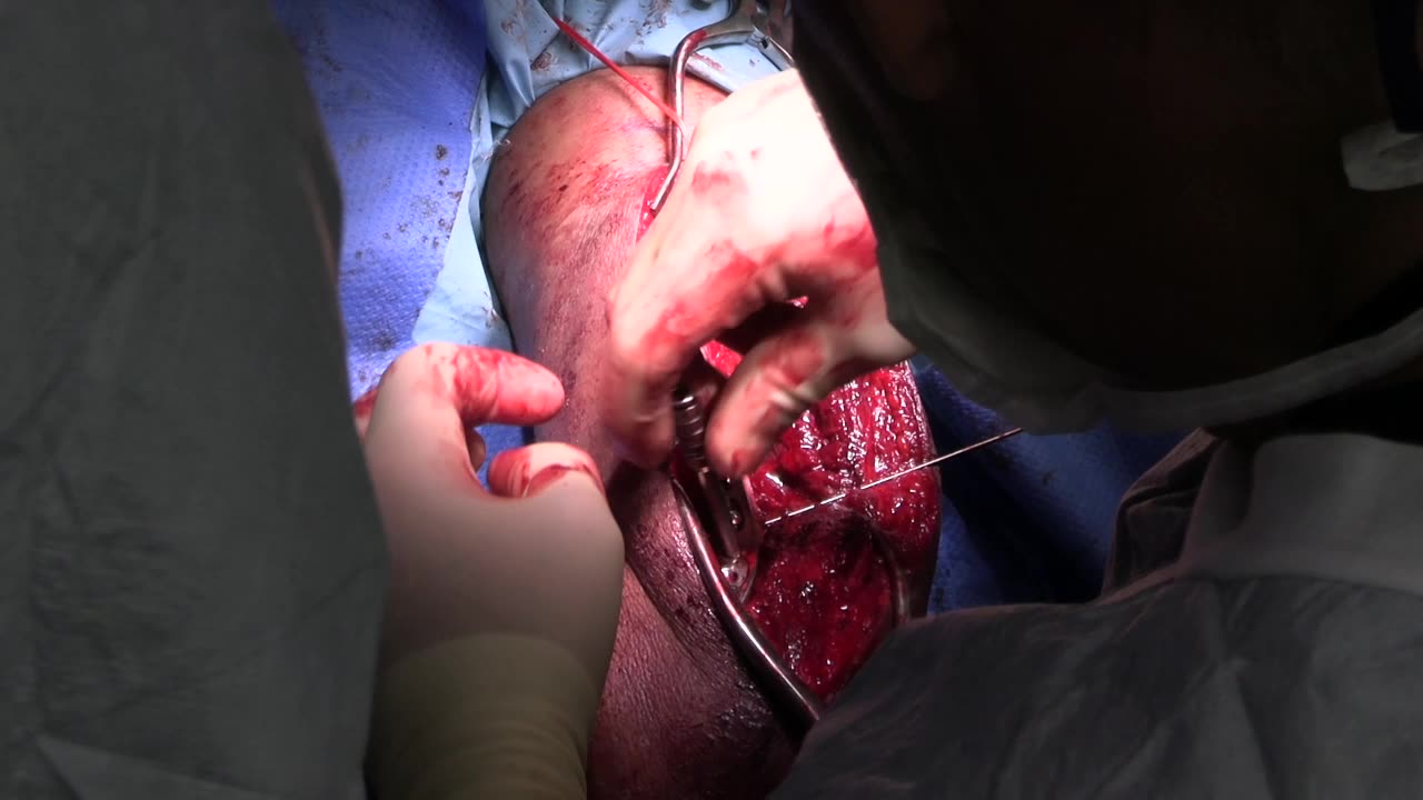 HUMERUS FRACTURE