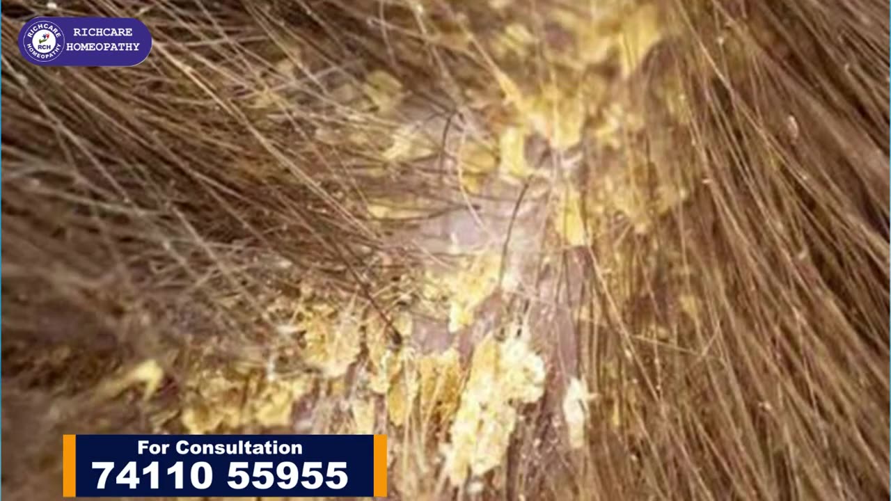 Hair Fall Solution | Hair Fall Treatment | Medicines for Hair Fall