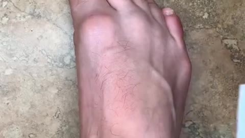 Another Level of Bunion Correction