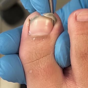 Dirty toenail trimming