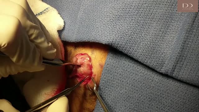 Cyst Removal