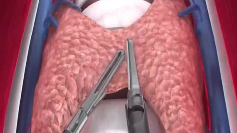 How To Remove Thiroadgland / Thairoaidgland ko kase nikala jata h