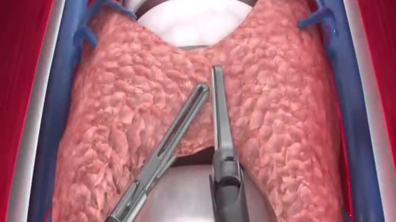 How To Remove Thiroadgland / Thairoaidgland ko kase nikala jata h