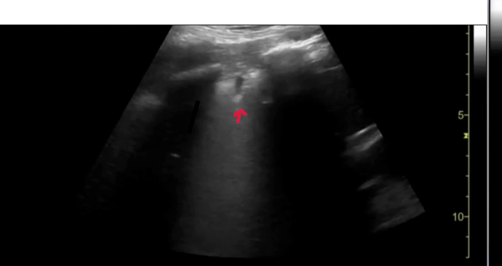 Lung Ultrasound Consolidation