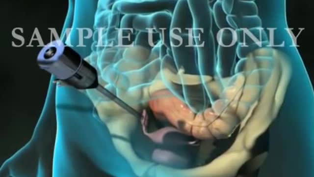 Diagnostic pelvie laparoscopy Exam