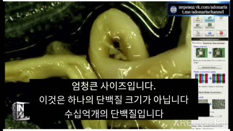 혈전사고 6(심장)