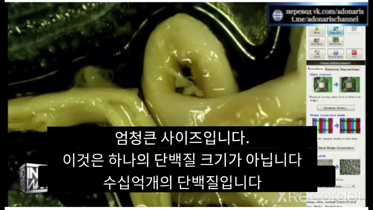 혈전사고 6(심장)