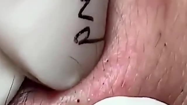 Blackheads & Milia, Big Cystic Acne Blackheads Extraction Whiteheads Removal Pimple Popping