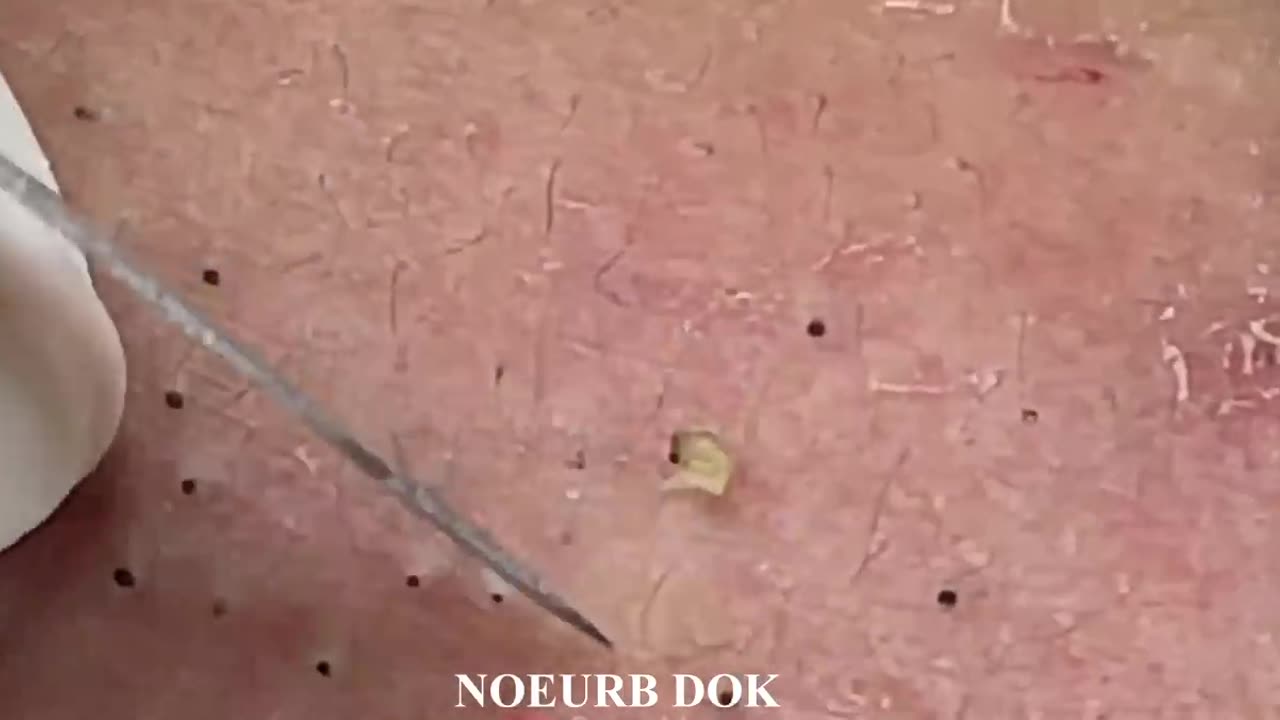 Popping Tons Of Blackheads