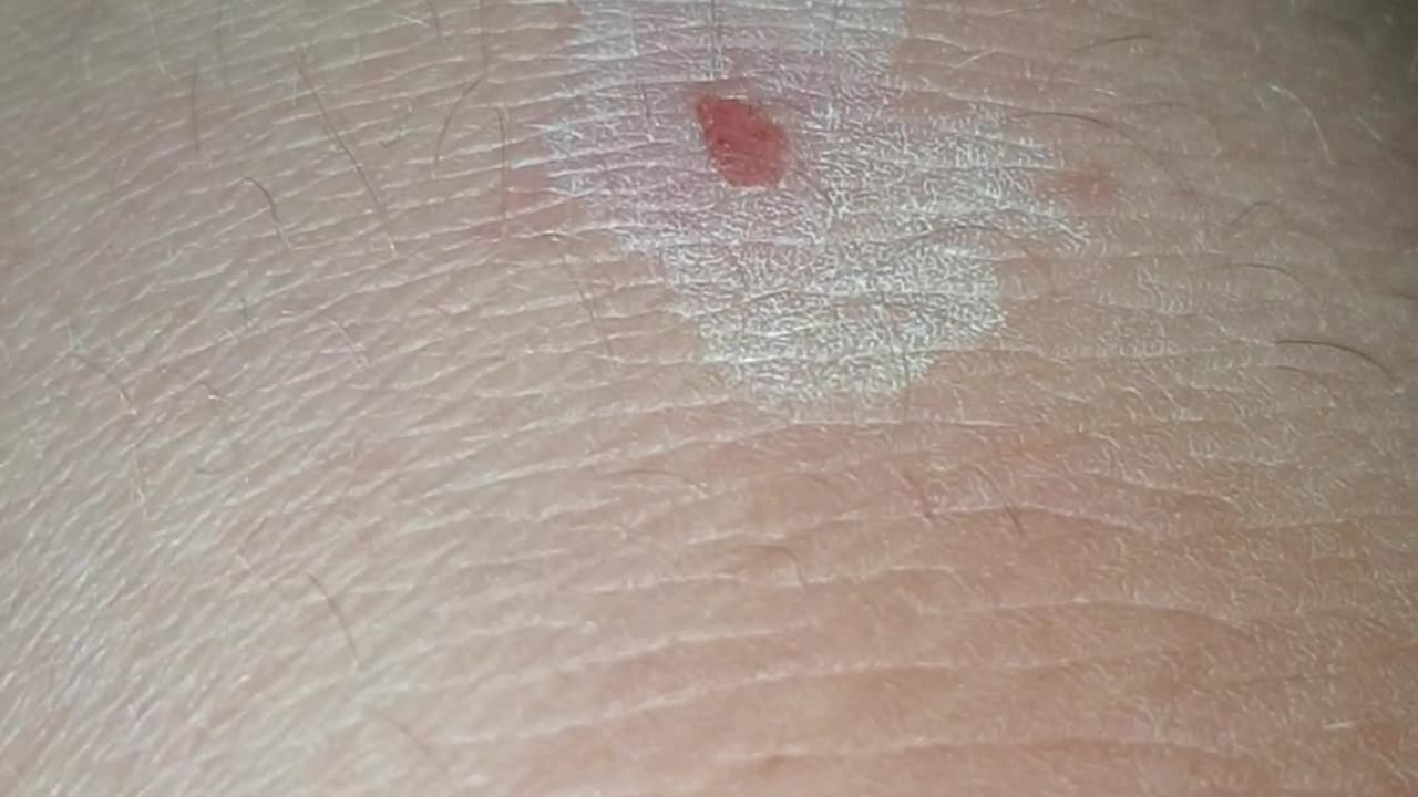 Oregano Oil Recurring Ingrown Hair