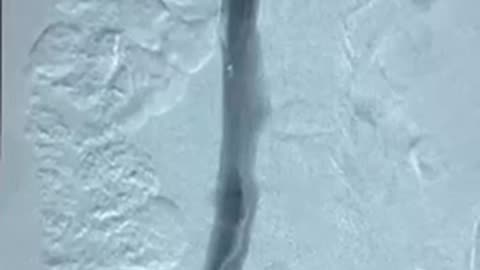 Inferior Vena Cava Filter
