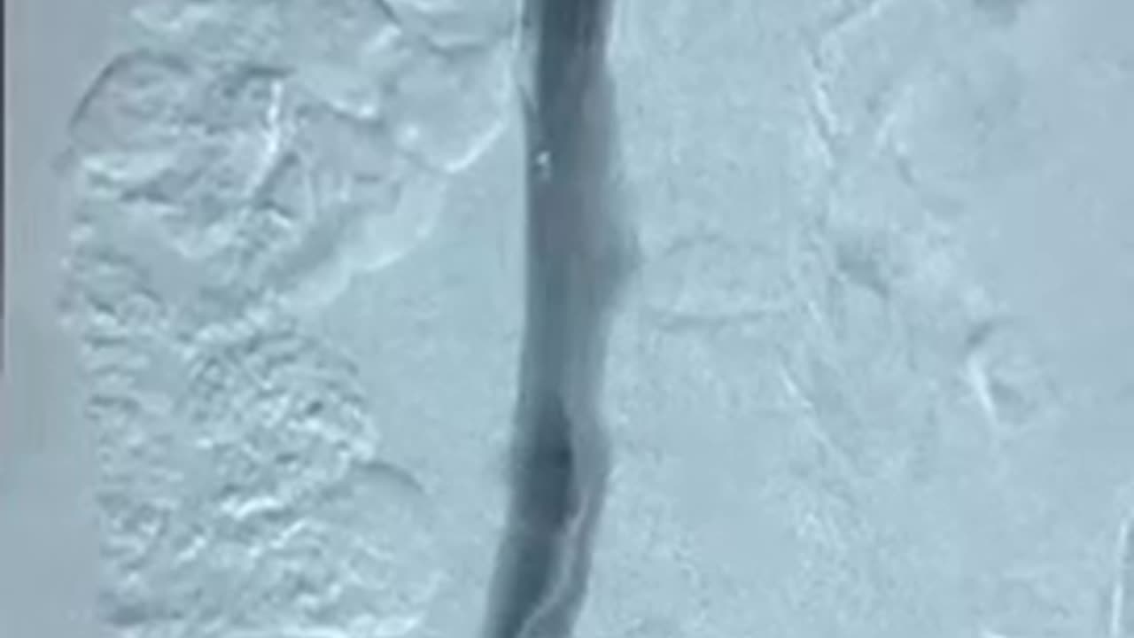 Inferior Vena Cava Filter