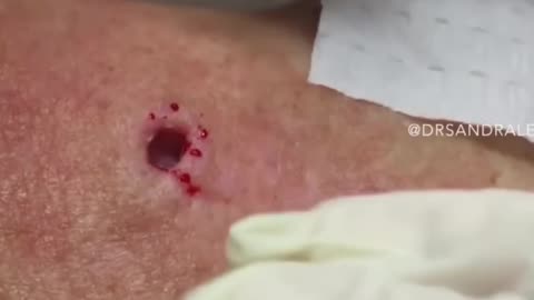 85 Year Old Blackhead! Dr Pimple Popper Most Popular Pop of ALL TIME!