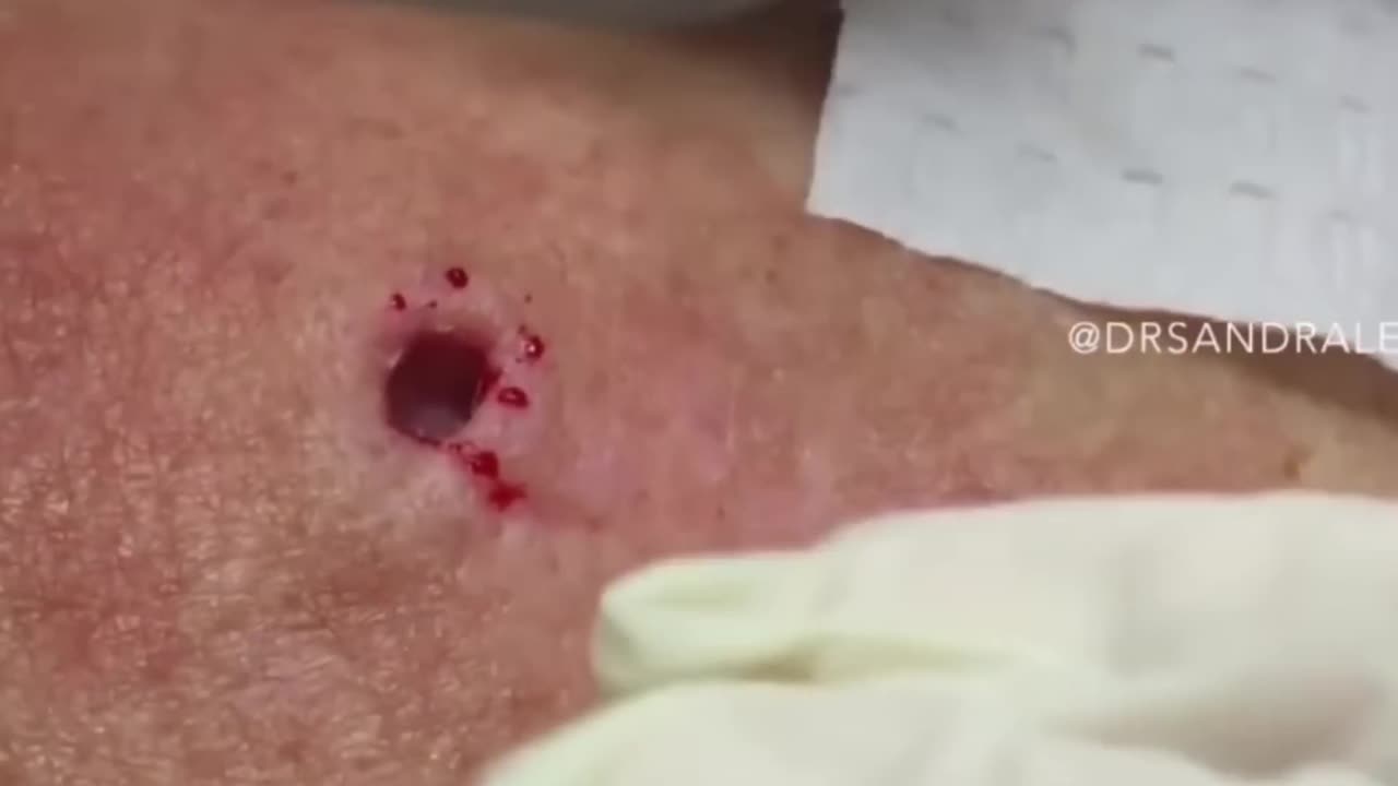 85 Year Old Blackhead! Dr Pimple Popper Most Popular Pop of ALL TIME!