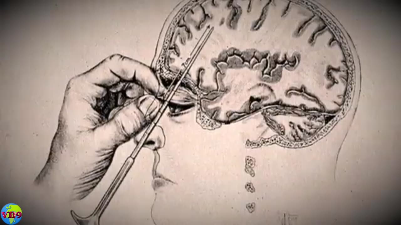 The Dark Side of Science: Is Lobotomy the Worst Surgery in History?