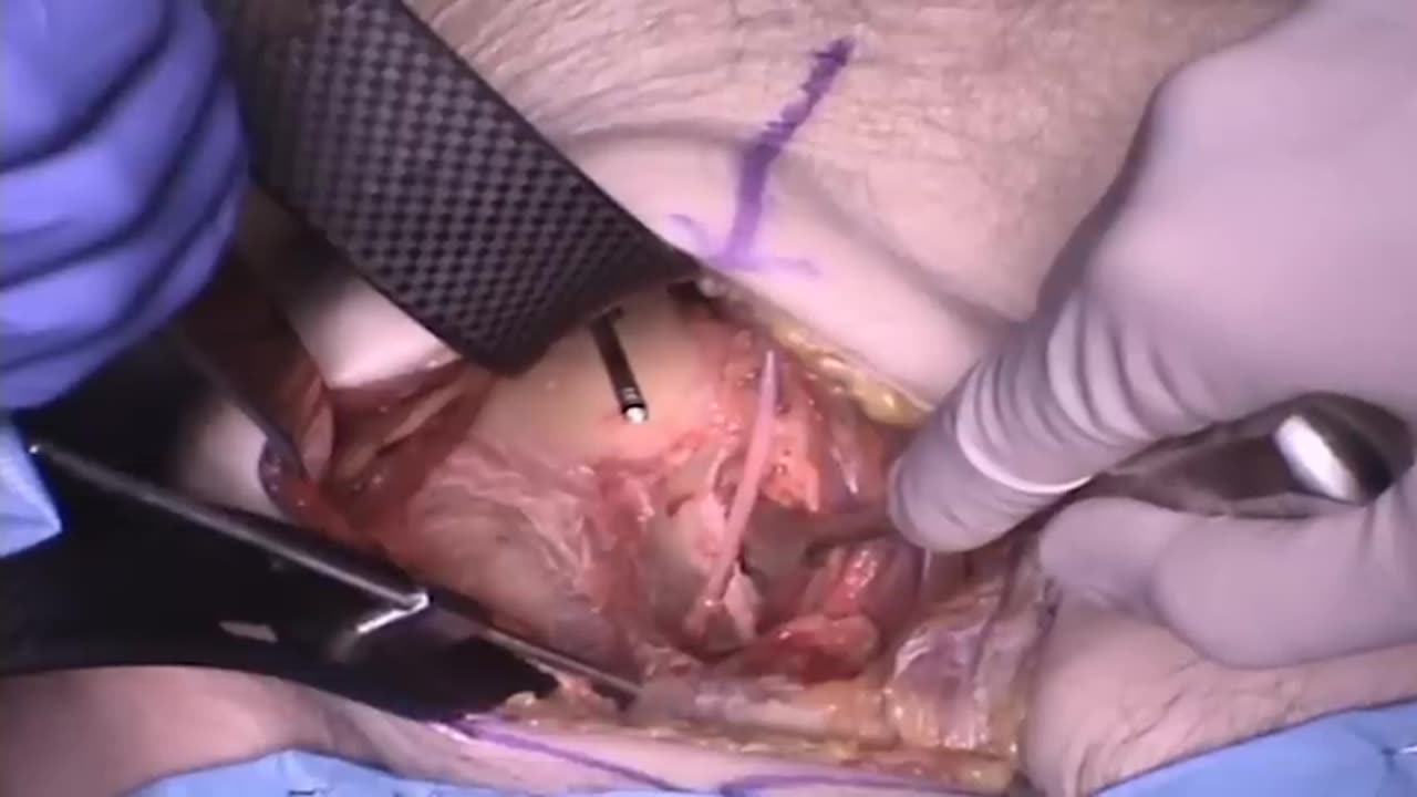 Claude Sagi - Anterior Intrapelvic Approach