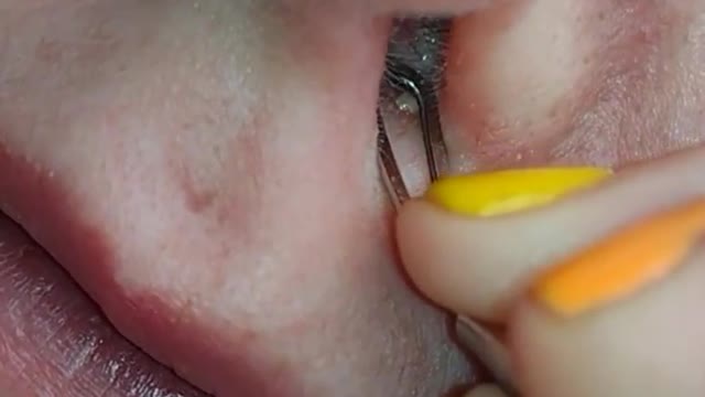 Blackhead Removal - Pimple popping - Acne Treatment - 12 #shorts