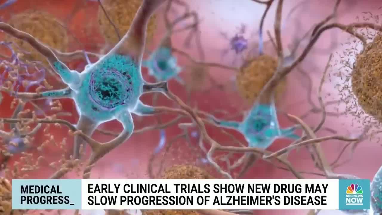 EARLY CLINICAL TRIALS SHOW NEW DRUG MAY SLOW PROGRESSION OF ALZHEIMER'S DISEASE