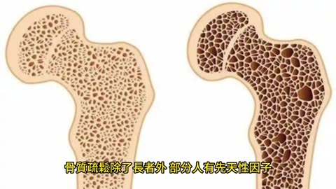 骨質疏鬆症 全球第2大流行病