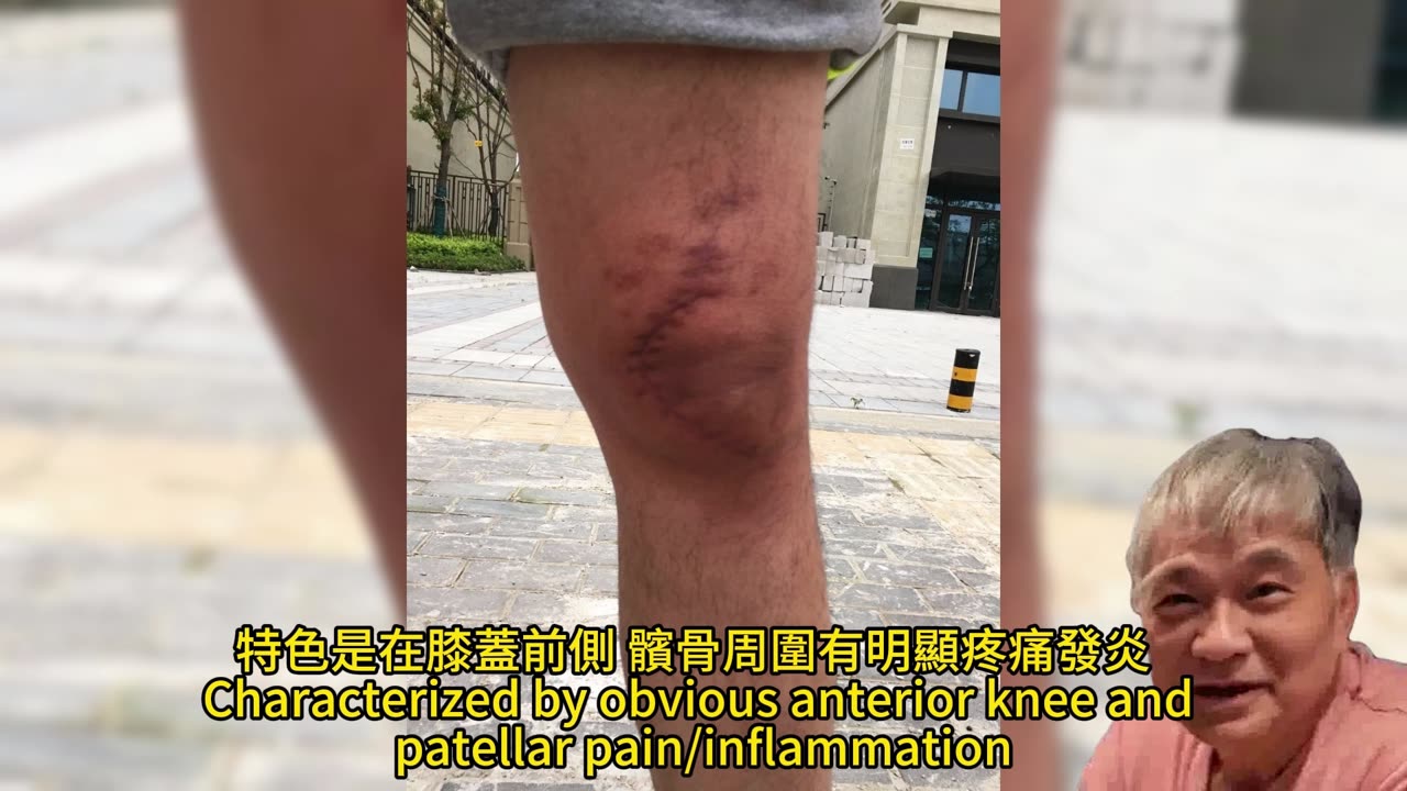 穿高筒鞋 防運動腳扭傷?