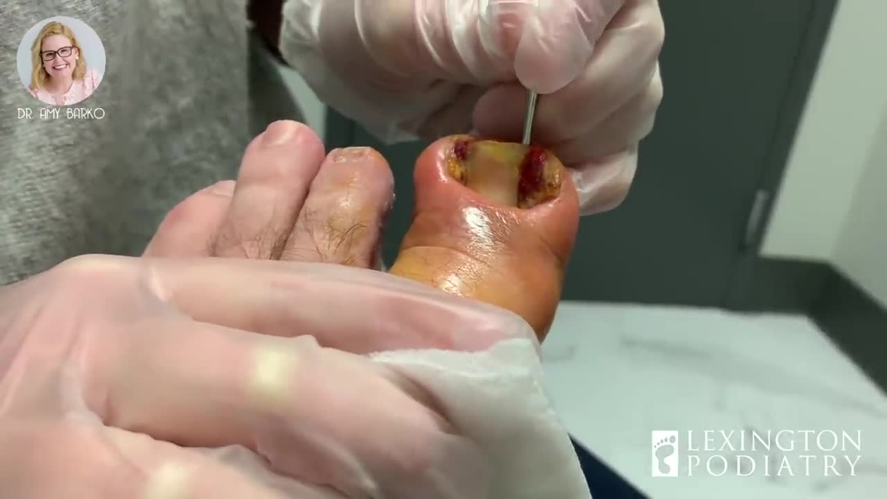 Epic Ingrown Ever. MUST WATCH!
