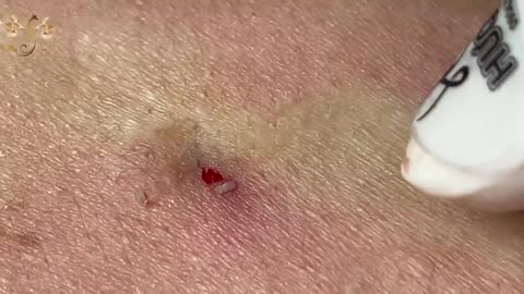 #113 | Acne Treatment Huong Beauty | How wonderful
