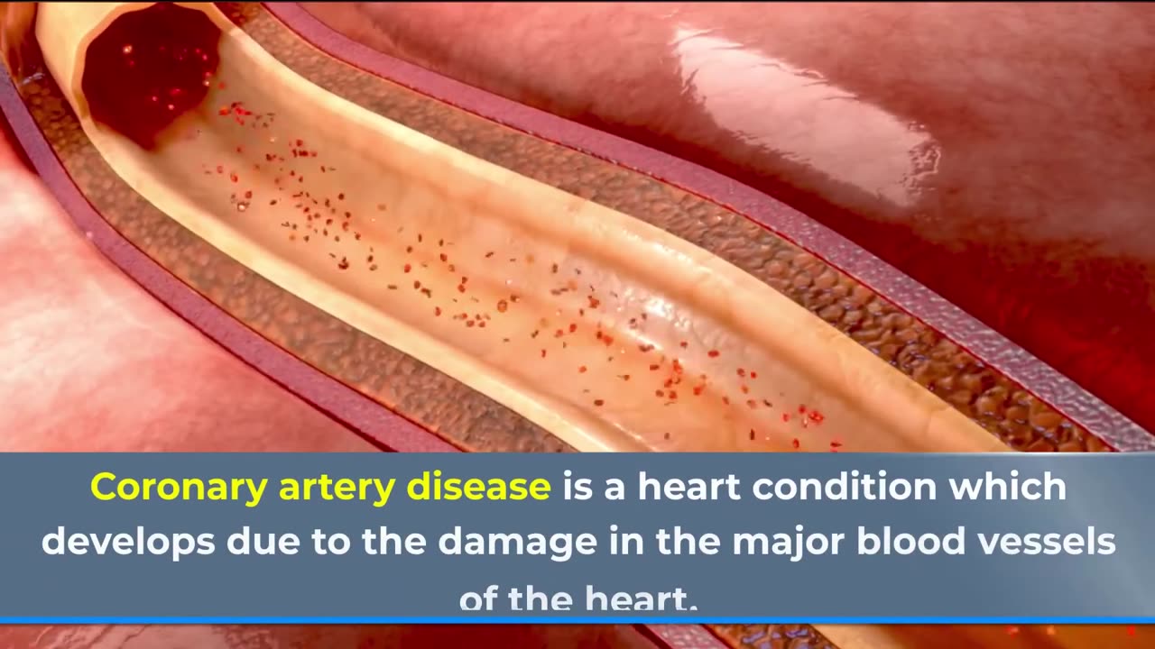 coronary artery disease