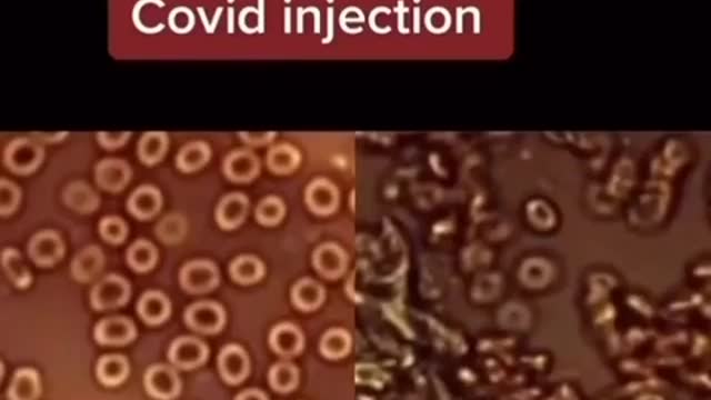 Blood before and after Moderna vaccine jab👆