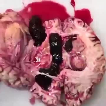 Human brain after the lethal mRNA vaccines