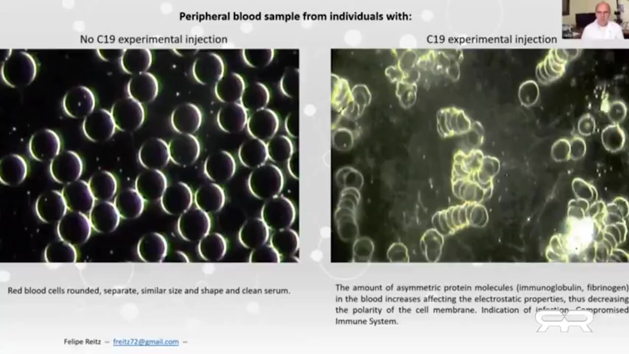 THERMOGRAPHIC IMAGING SHOWS MASSIVE BLOOD CLOTS IN THE