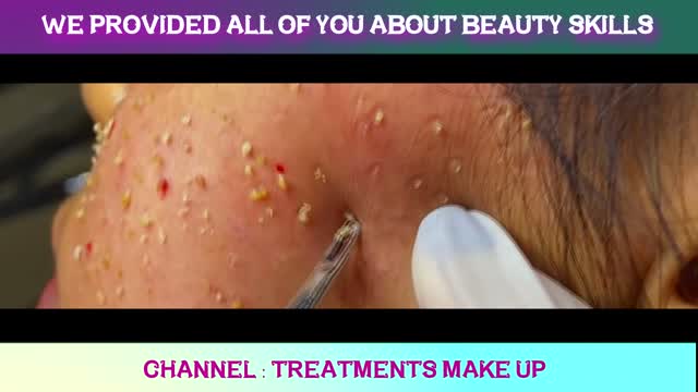 REMOVAL BLACKHEADS ON LIPS 02