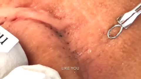 Blackhead Removal Videos 2021!