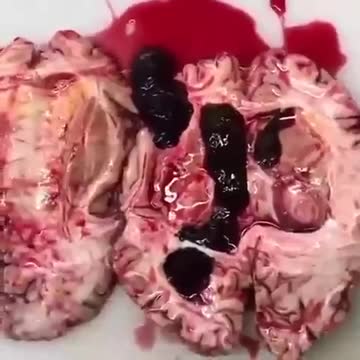 Blood clots in brain, following Covid shot