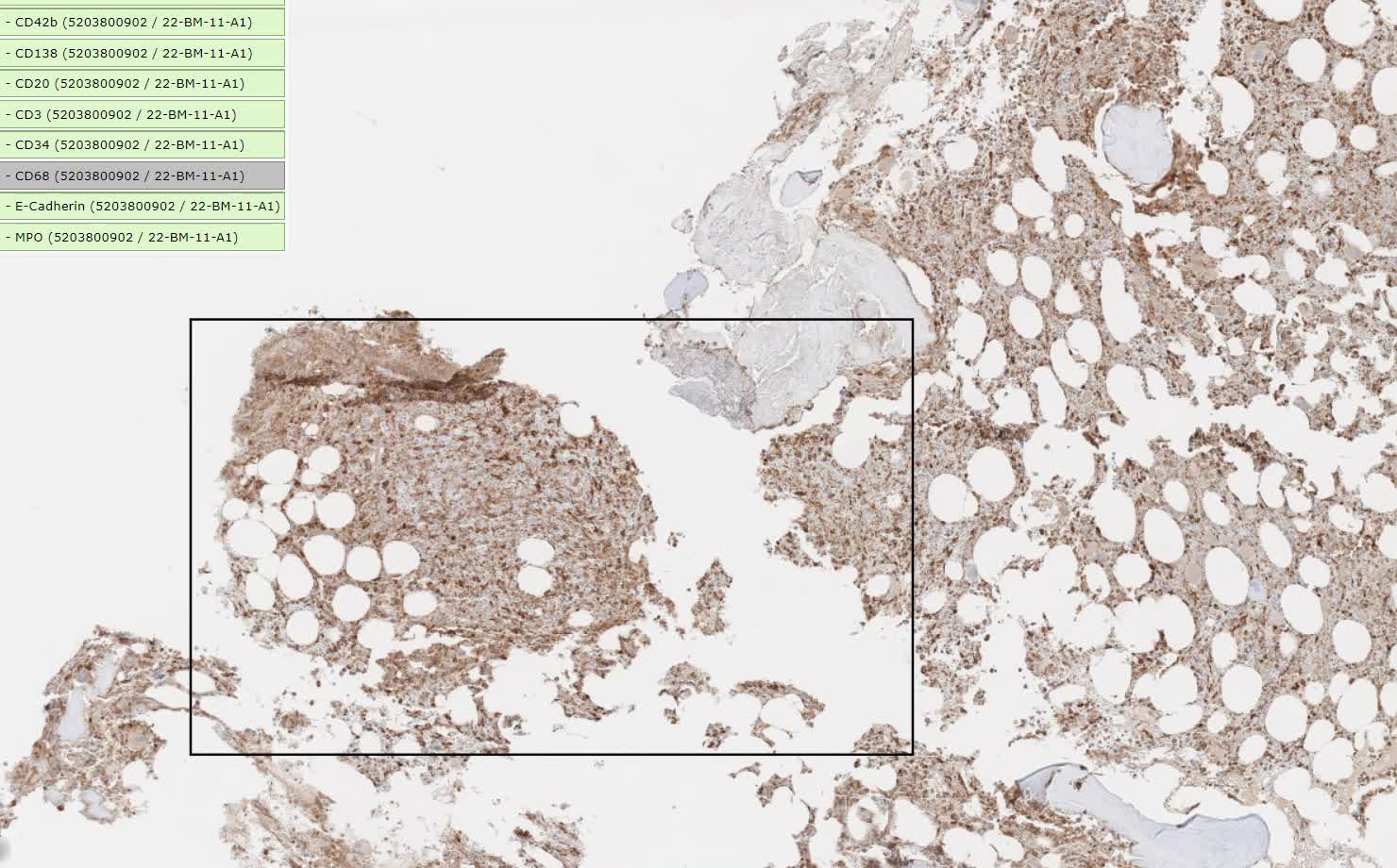 bm11, odd marrow infiltrate