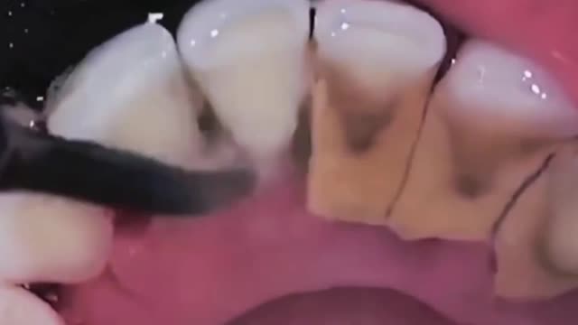 Full intraoral scaling procedure (I)