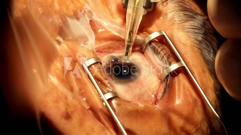 What to know about laser eye surgery