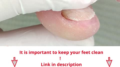 Sweeping of Skin - Educational footcare Video