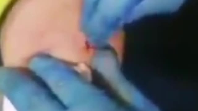 ( -0141 ) Please Only Watch If You're Not Squeamish About Blood - Purported Video Of Magnetic Removal of Graphene Oxide from Jab Site